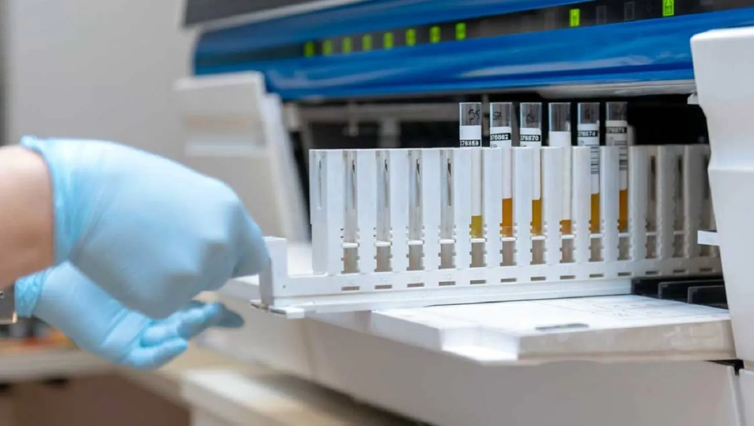 فحص جديد يكشف سرطان المثانة بدقة عالية